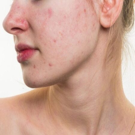 Simple Home Remedies For Red Spots On Skin